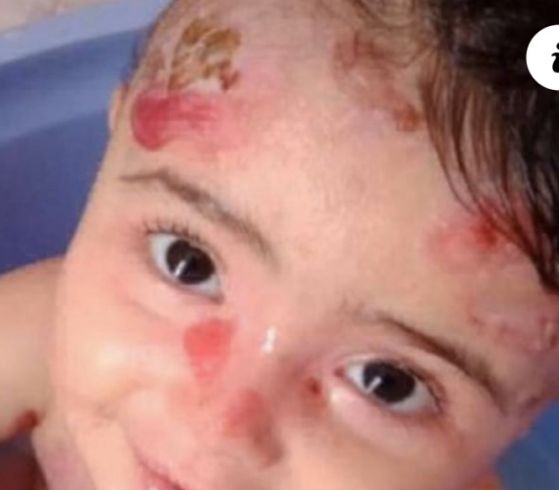 Aidez bayrem 2 ans atteint d’épidermolyse bulleuse génétique